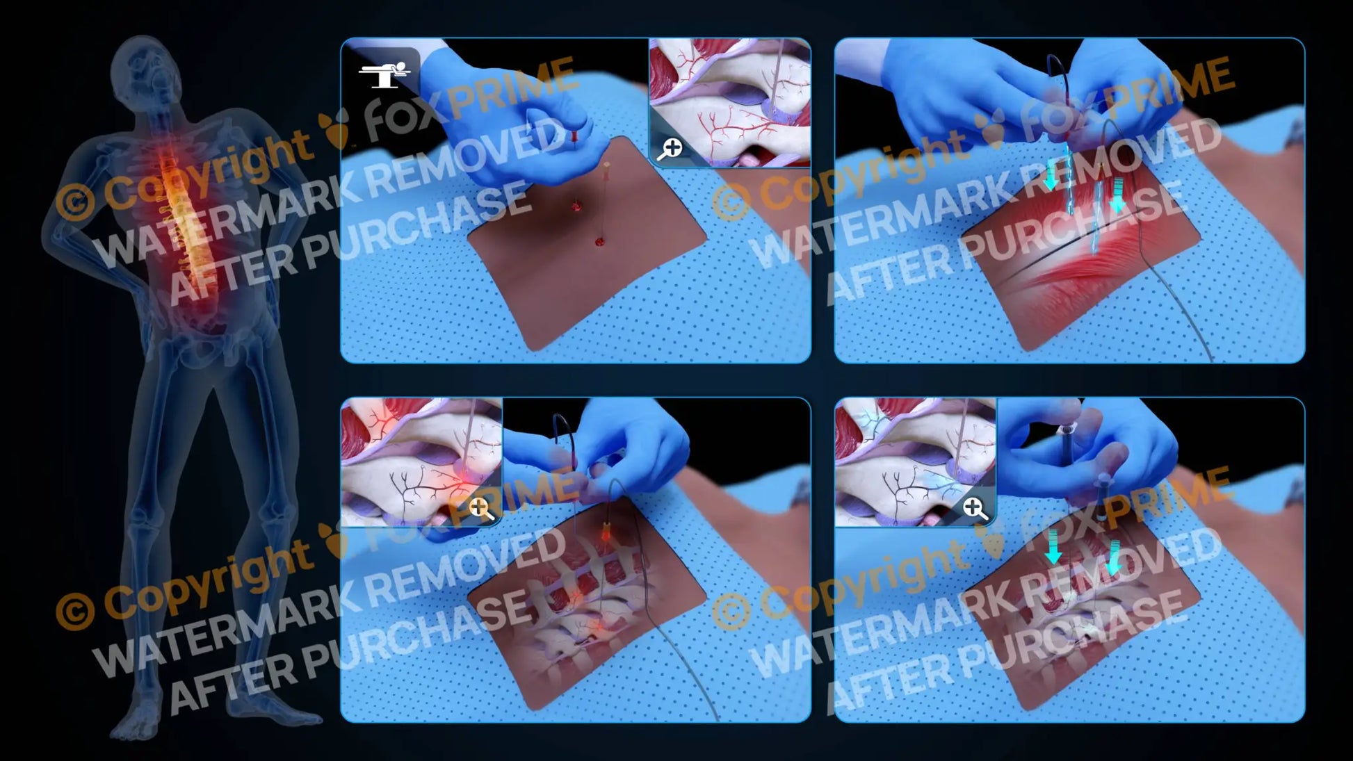 Bilateral Radiofrequency Ablation T7-T8 (No Text) - Still Shot