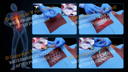 Bilateral Radiofrequency Ablation T7-T8 (No Text) - Still Shot