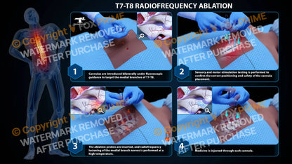 Bilateral Radiofrequency Ablation T7-T8 (PowerPoint) - PowerPoint