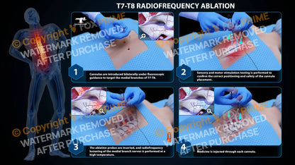 Bilateral Radiofrequency Ablation T7-T8 - Still Shot