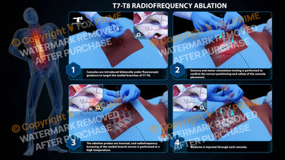 Bilateral Radiofrequency Ablation T7-T8 - Still Shot