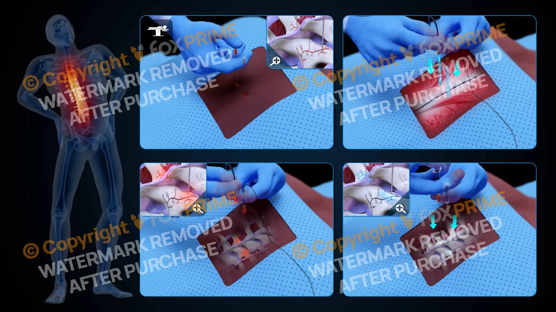 Bilateral Radiofrequency Ablation T8-T9 (No Text) Still Shot