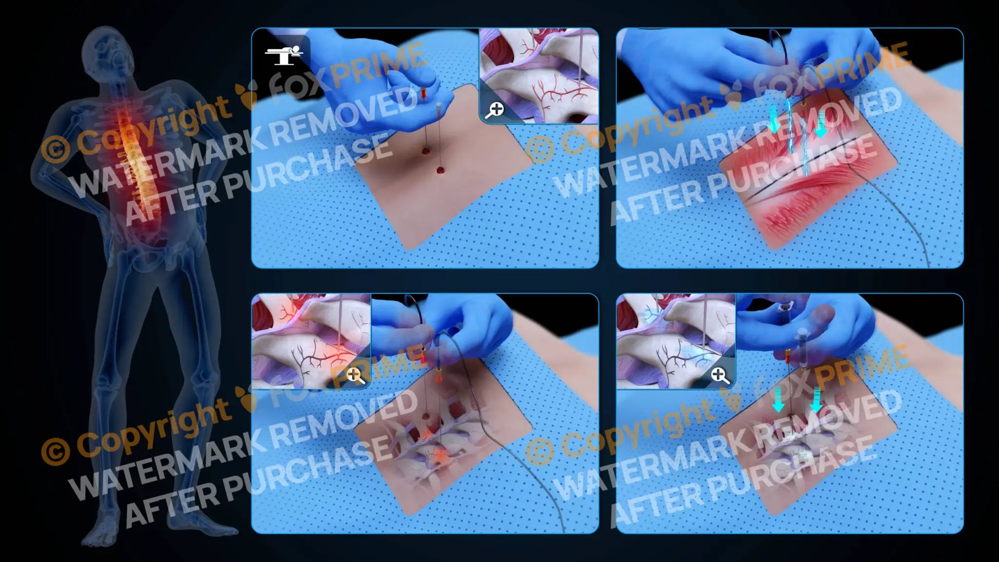 Bilateral Radiofrequency Ablation T8-T9 (No Text) Still Shot