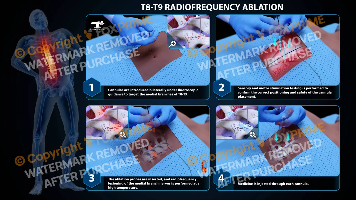Bilateral Radiofrequency Ablation T8-T9 (PowerPoint) PowerPoint
