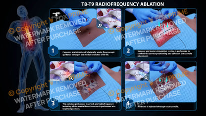 Bilateral Radiofrequency Ablation T8-T9 (PowerPoint) PowerPoint