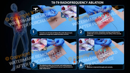 Bilateral Radiofrequency Ablation T8-T9 Still Shot