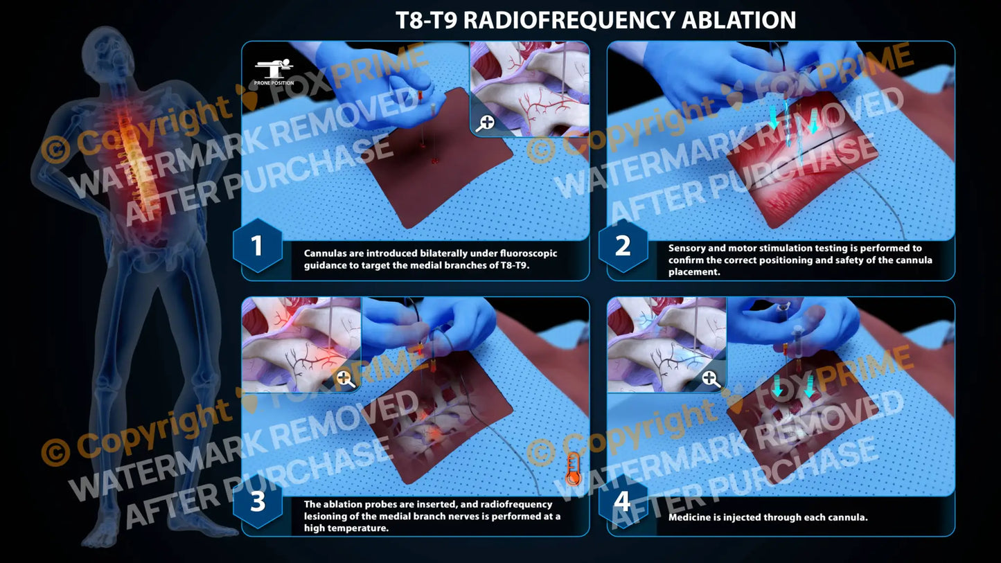 Bilateral Radiofrequency Ablation T8-T9 Still Shot