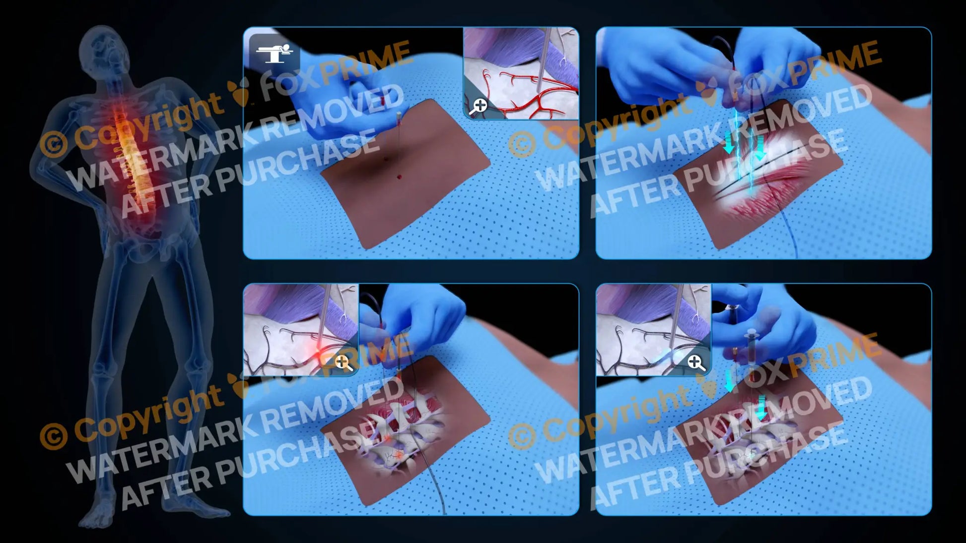 Bilateral Radiofrequency Ablation T9-T10 (No Text) Still Shot