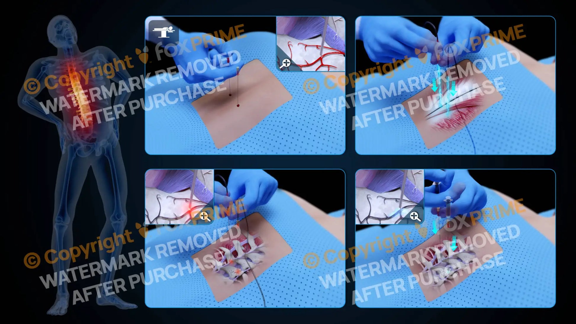 Bilateral Radiofrequency Ablation T9-T10 (No Text) - Still Shot