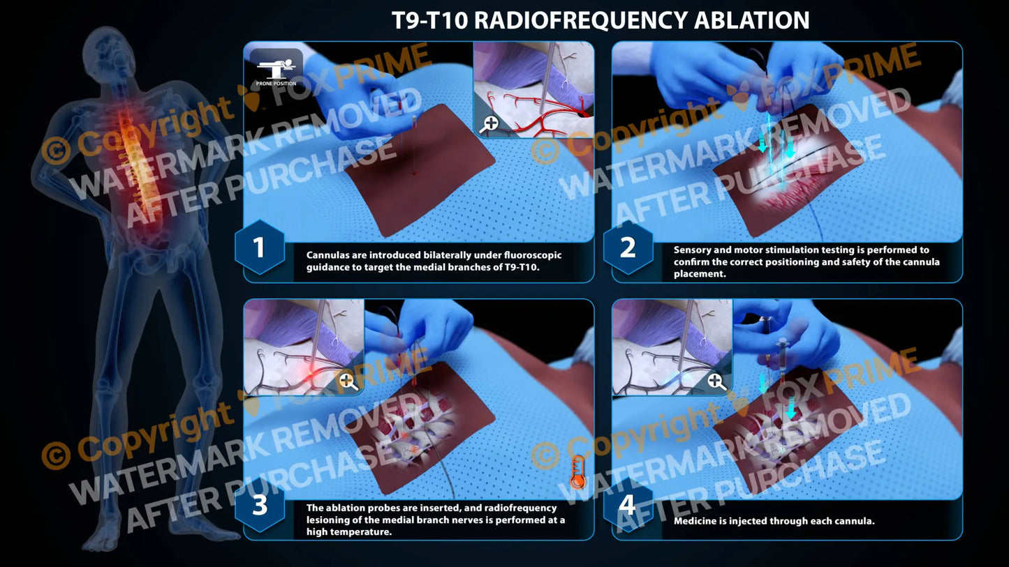 Bilateral Radiofrequency Ablation T9-T10 Still Shot