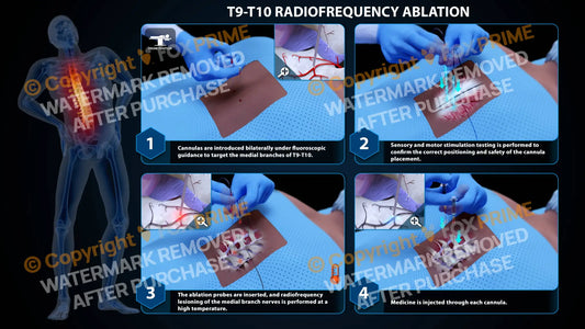 Bilateral Radiofrequency Ablation T9-T10 Still Shot