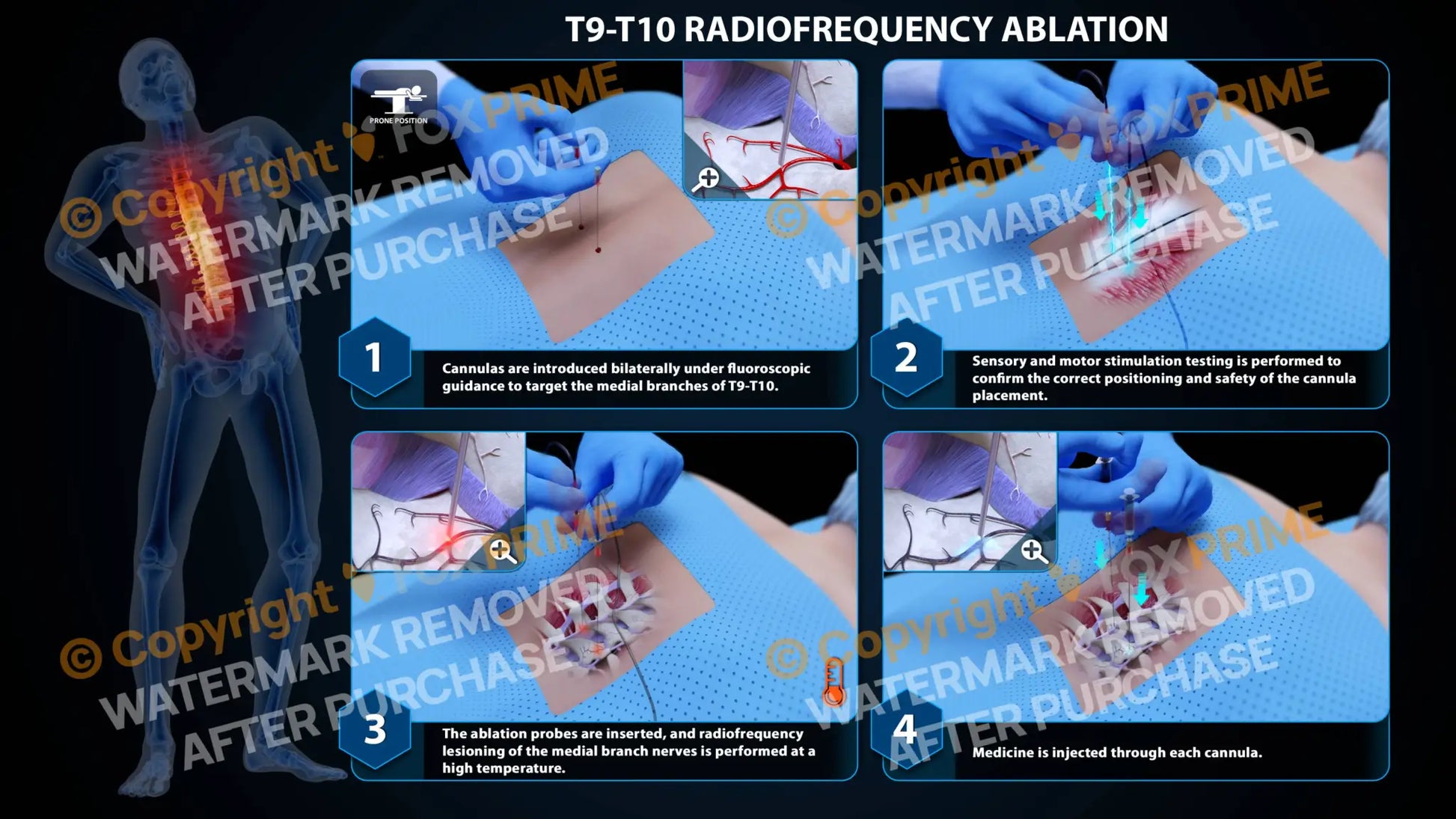 Bilateral Radiofrequency Ablation T9-T10 - Still Shot