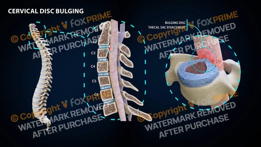 Cervical Bulging C2-3 Still Shot