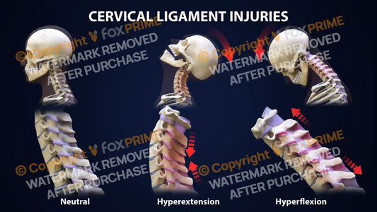 Cervical Ligament Injuries Still Shot