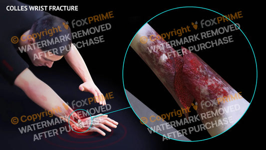Colles Wrist Fracture Single Use / Male / Light Still Shot