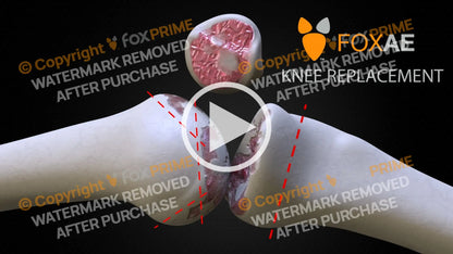 CUSTOM KNEE Knee Replacement. / Animation