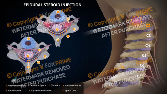 Epidural Steroid Injections Left C1-2 Single Use / Light Still Shot