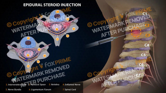 Epidural Steroid Injections Left C2-3 Single Use / Light Still Shot