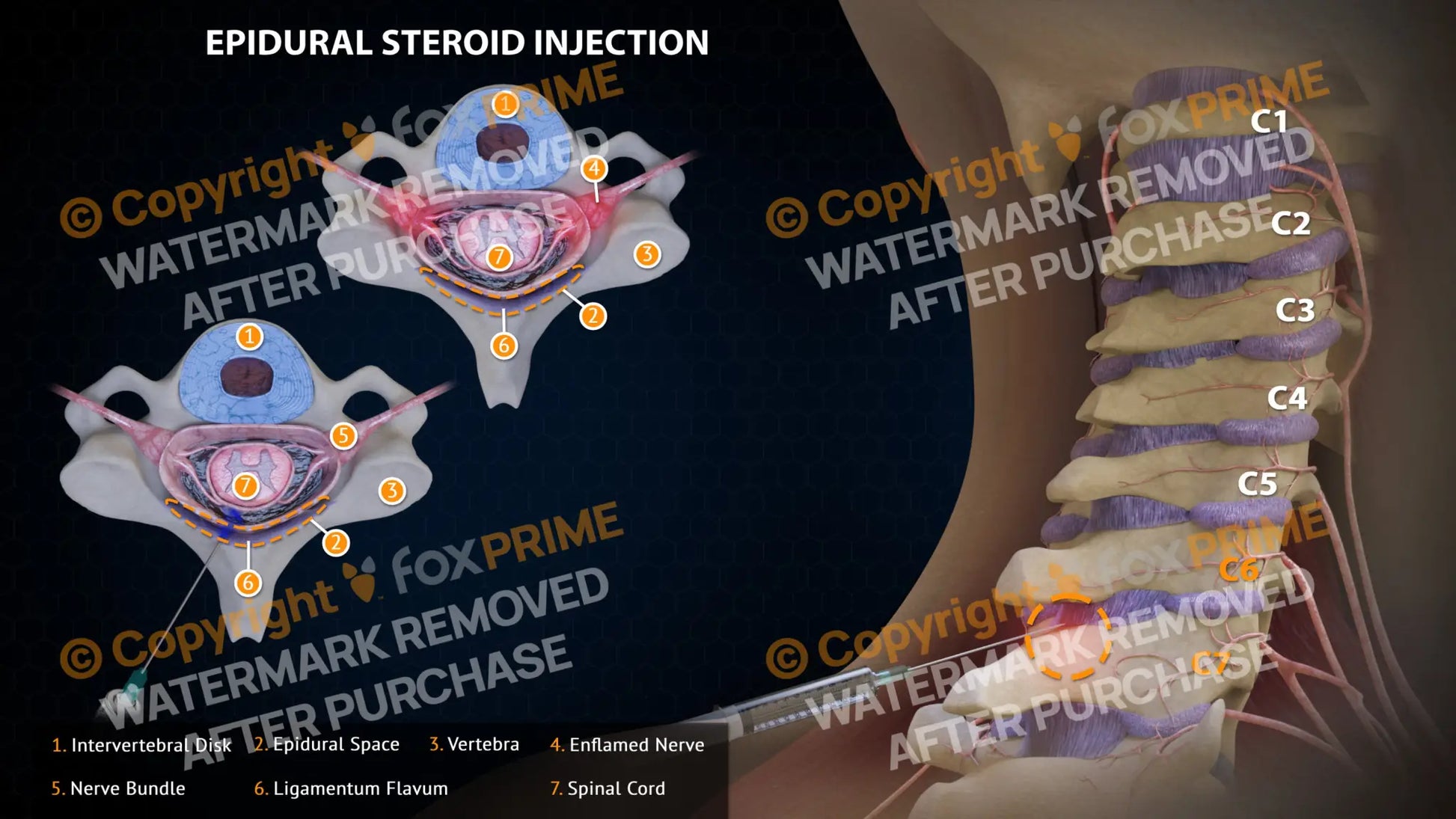 Epidural Steroid Injections Left C6-7 Single Use / Light Still Shot