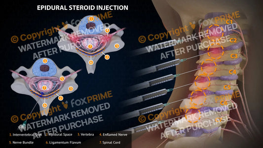 Epidural Steroid Injections Left Single Use / Light Still Shot