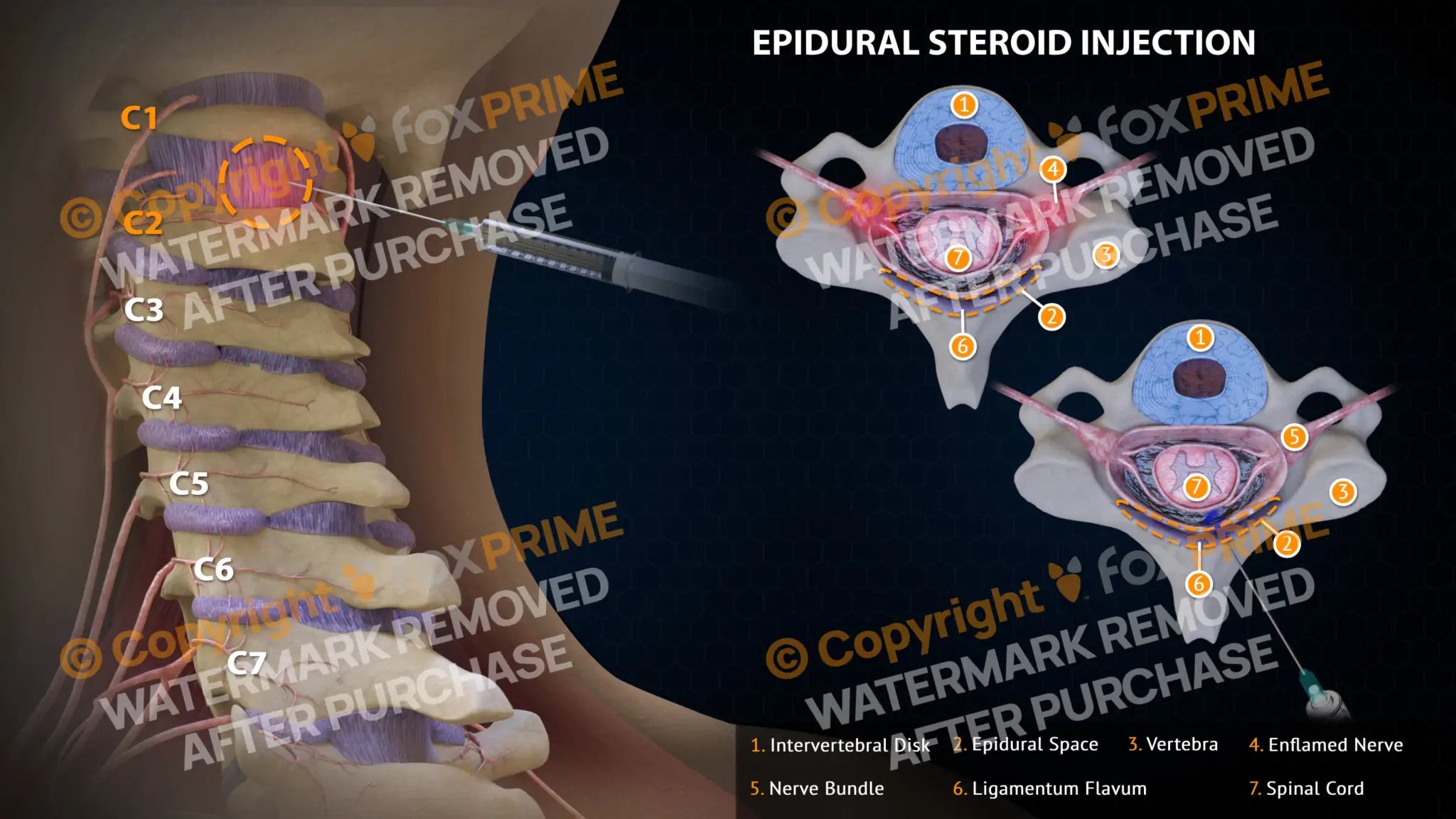 Epidural Steroid Injections Right C1-2 – FoxPrime