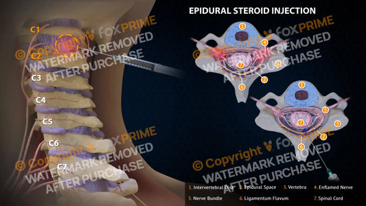 Button Back Injections Spinal Injections – FoxPrime