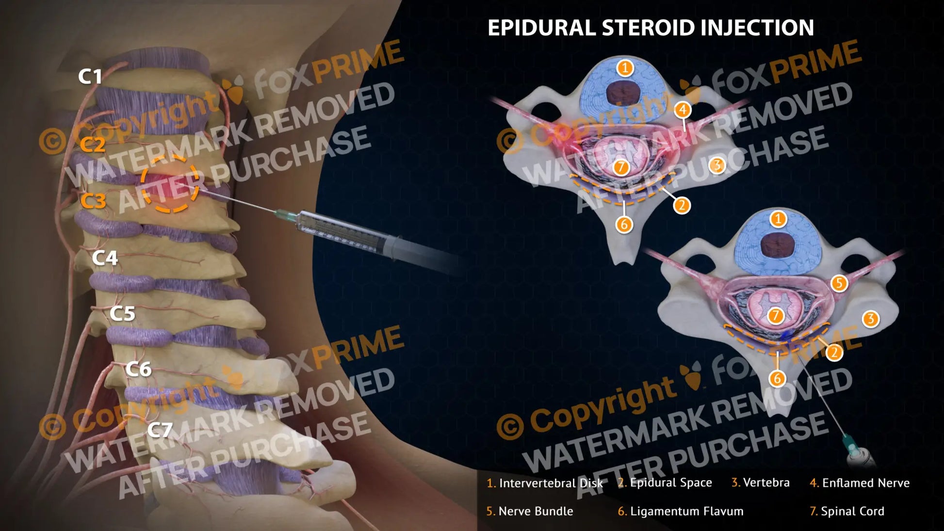 Epidural Steroid Injections Right C2-3 Single Use / Light Still Shot
