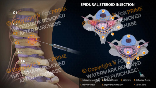 Epidural Steroid Injections Right C3-4 Single Use / Light Still Shot