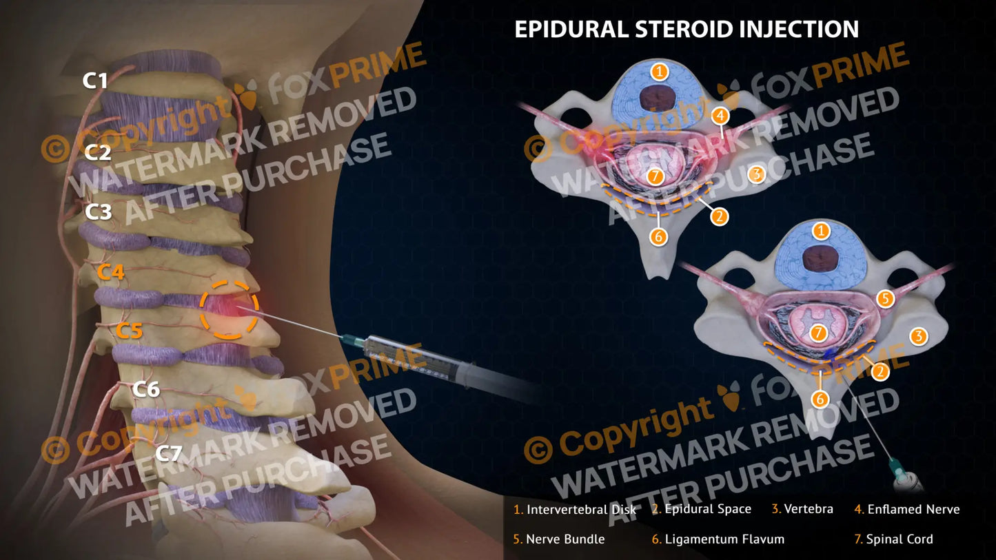 Epidural Steroid Injections Right C4-5 Single Use / Light Still Shot