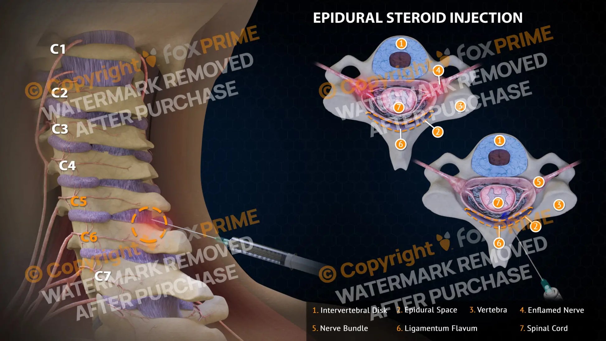 Epidural Steroid Injections Right C5-6 Single Use / Light Still Shot