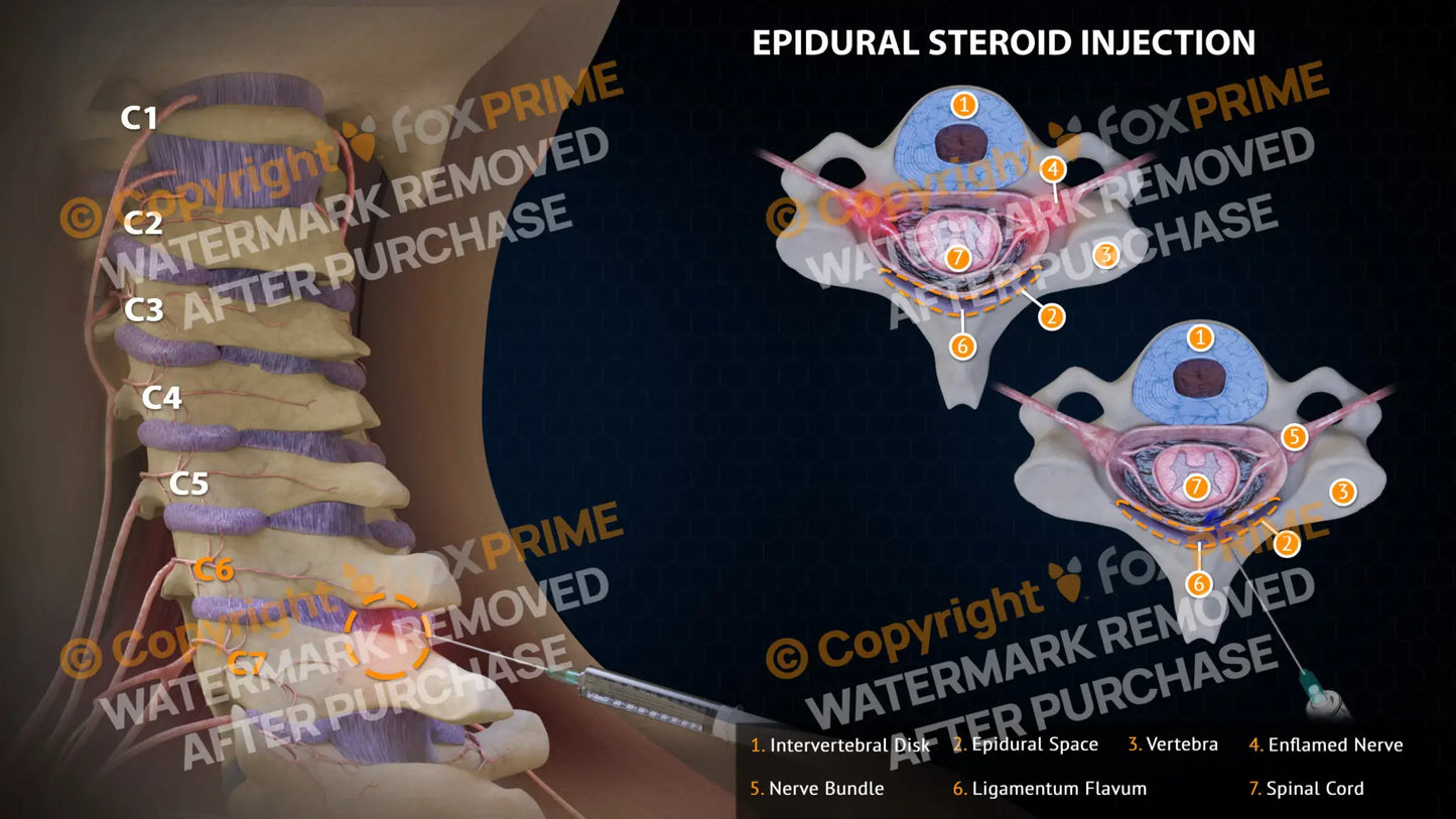 Epidural Steroid Injections Right C6-7 Single Use / Light Still Shot