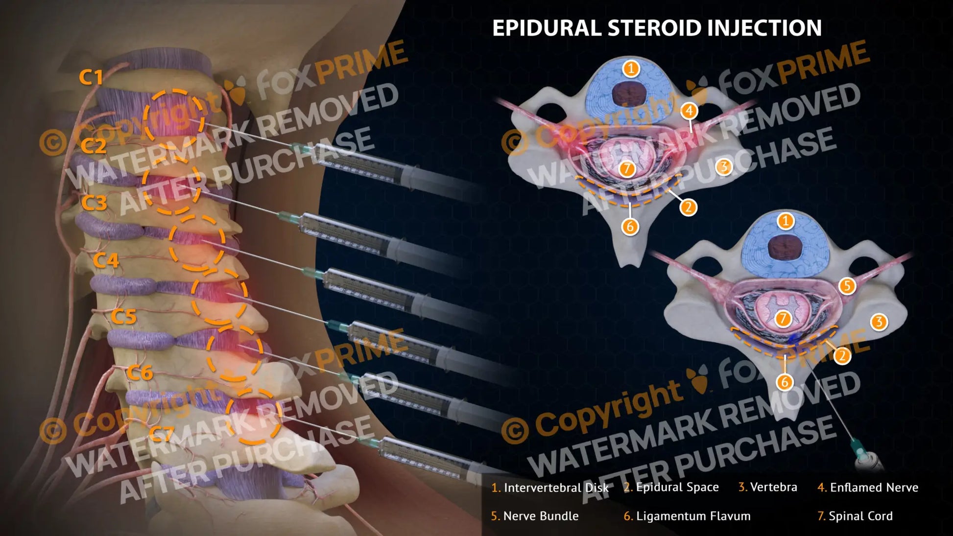 Epidural Steroid Injections Right Single Use / Light Still Shot