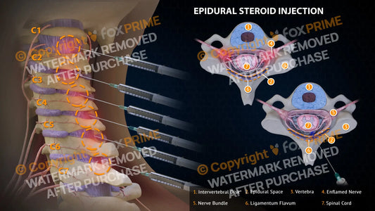 Epidural Steroid Injections Right Single Use / Light Still Shot