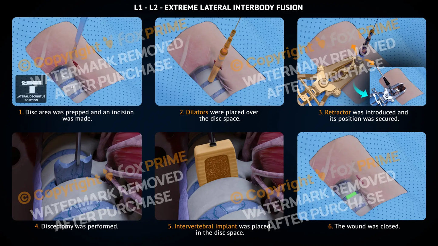 Extreme Lateral Interbody Fusion L1-L2 Left Single Use / Male Light Still Shot