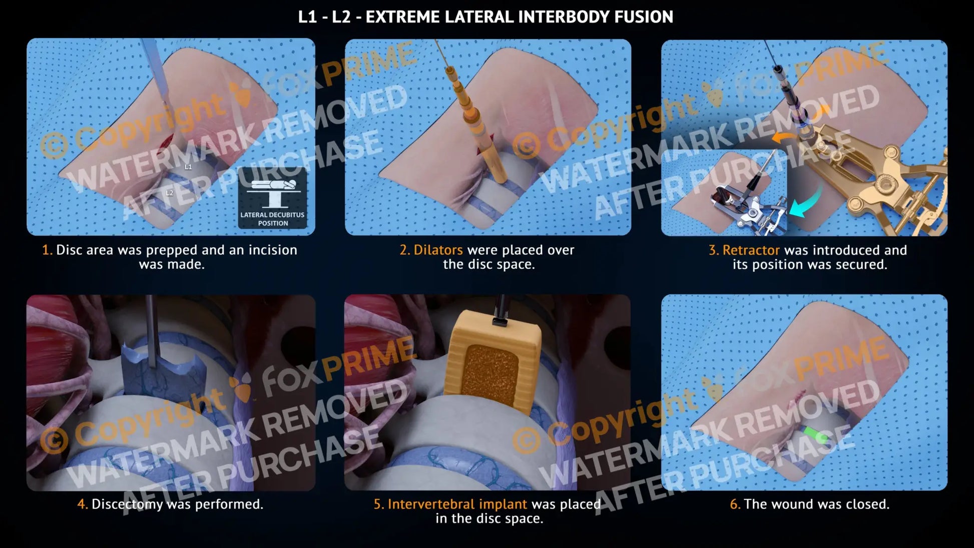 Extreme Lateral Interbody Fusion L1-L2 Right Single Use / Male Light Still Shot