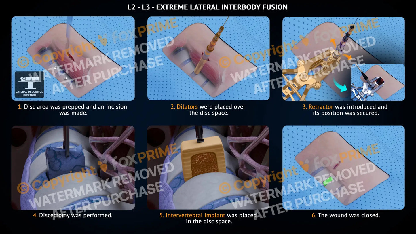 Extreme Lateral Interbody Fusion L2-L3 Left Single Use / Male Light Still Shot