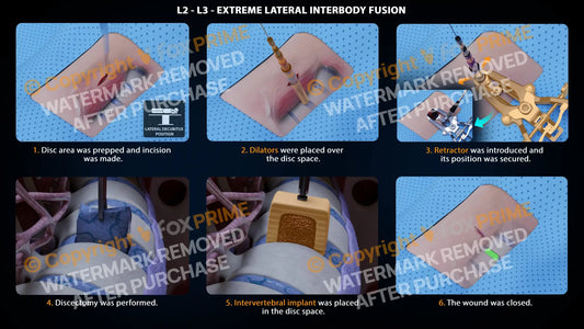 Extreme Lateral Interbody Fusion L2-L3 Right Single Use / Male Light Still Shot