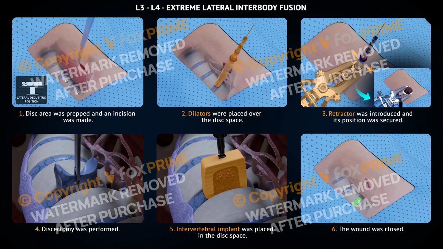 Extreme Lateral Interbody Fusion L3-L4 Left Single Use / Male Light Still Shot