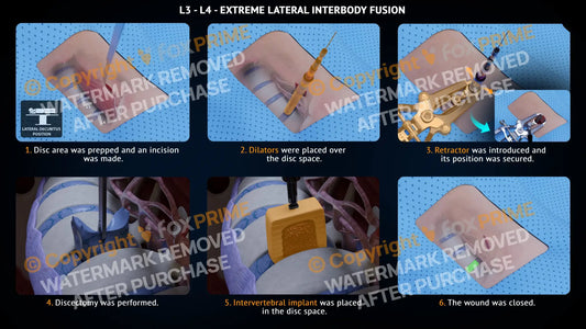 Extreme Lateral Interbody Fusion L3-L4 Left Single Use / Male Light Still Shot