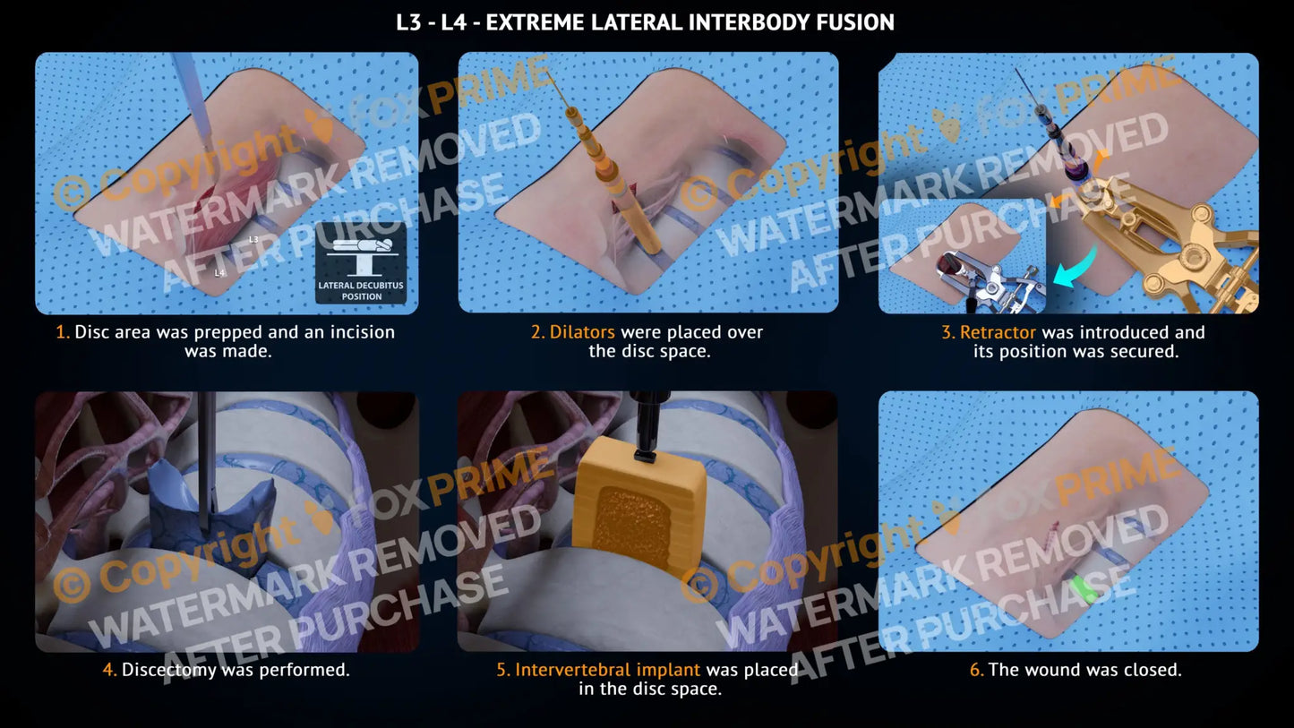 Extreme Lateral Interbody Fusion L3-L4 Right Single Use / Male Light Still Shot