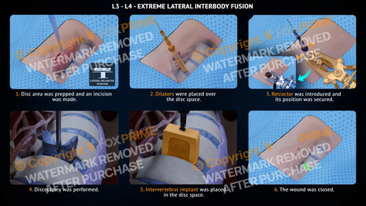 Extreme Lateral Interbody Fusion L3-L4 Right Single Use / Male Light Still Shot