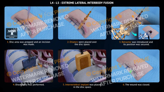 Extreme Lateral Interbody Fusion L4-L5 Left Single Use / Male Light Still Shot