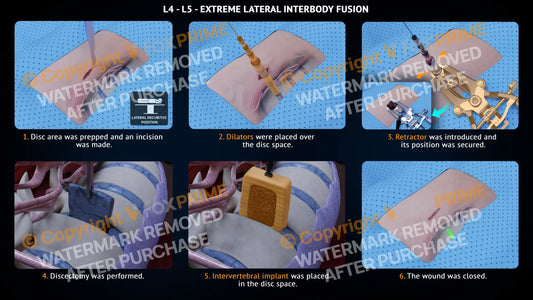 Extreme Lateral Interbody Fusion L4-L5 Right Single Use / Male Light Still Shot