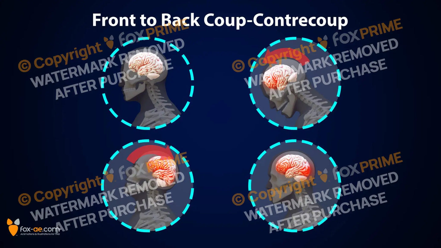 Front To Back Coup-Contrecoup Still Shot