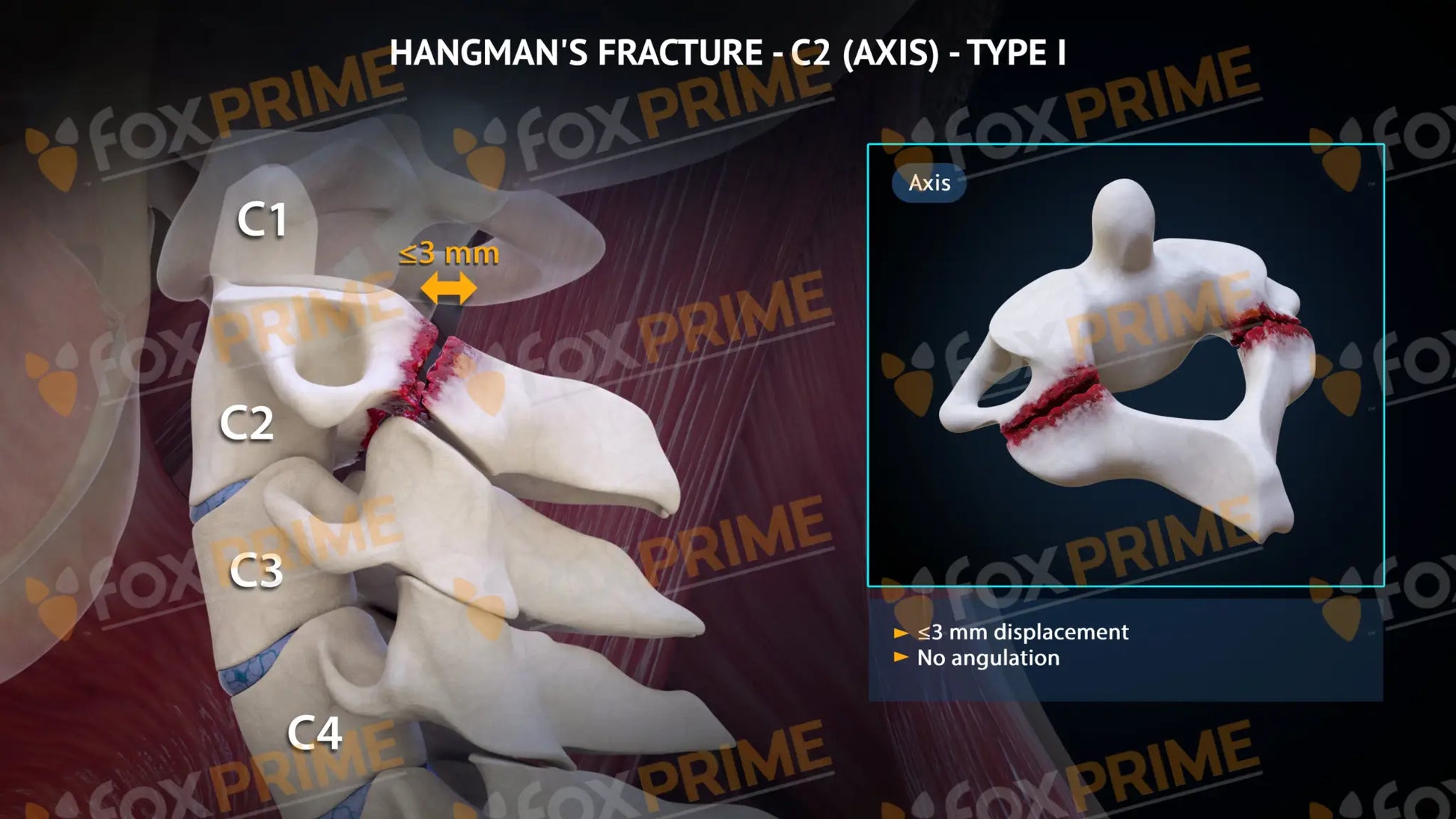 Hangman’s Fracture Type I Still Shot