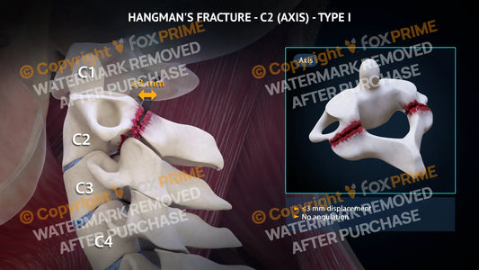 Hangman’s Fracture Type I Still Shot