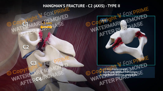 Hangman’s Fracture Type Ii Still Shot