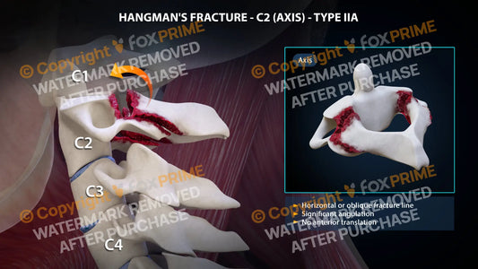 Hangman’s Fracture Type Iia Still Shot