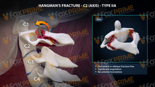 Hangman’s Fracture Type Iia Still Shot