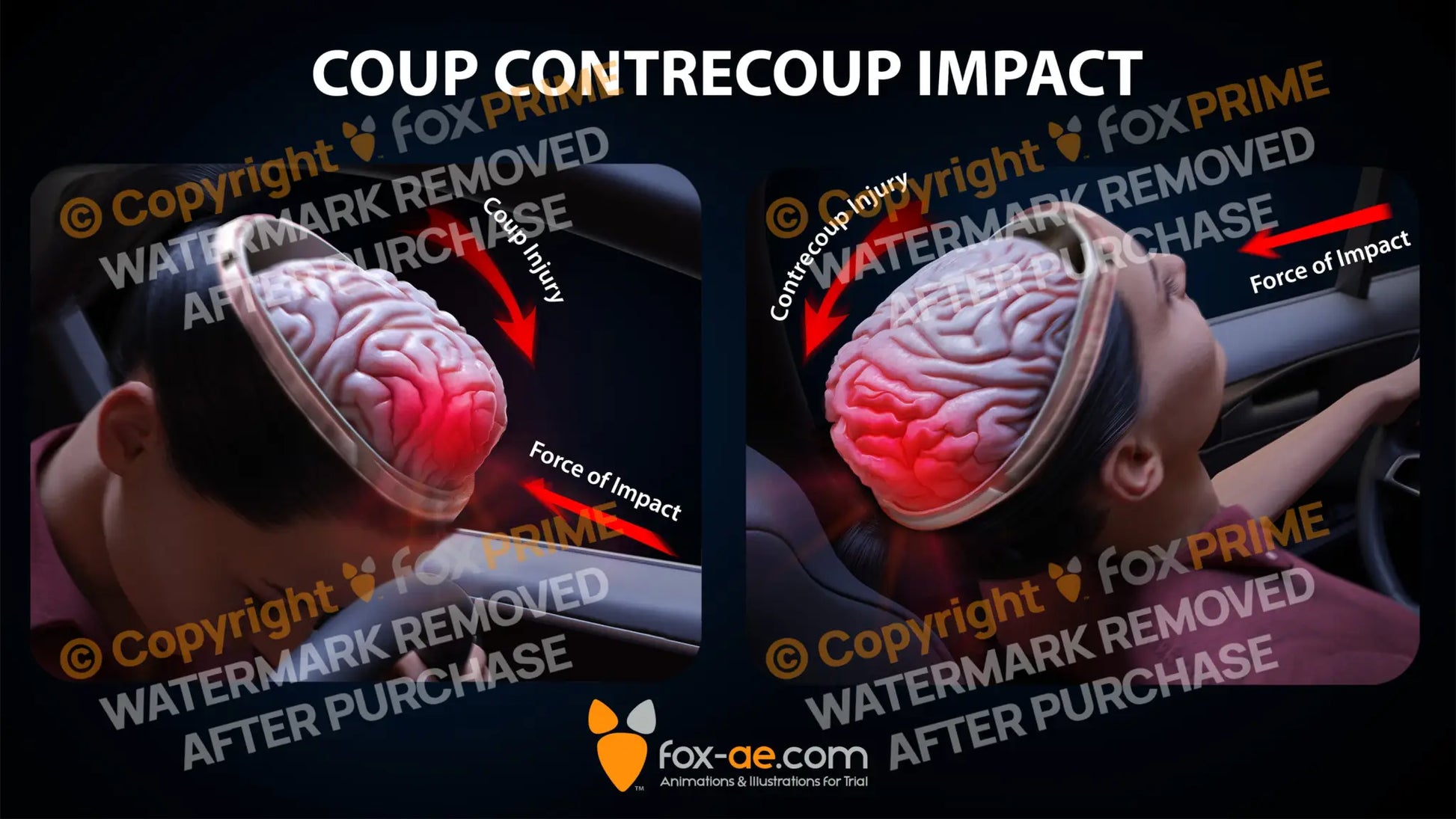 Head On Coup Contrecoup Single Use / Female Light Still Shot